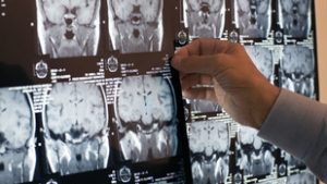 Agykutatási áttörés: magyar tudósok felfedezése segítheti az Alzheimer és a skizofrénia gyógyítását